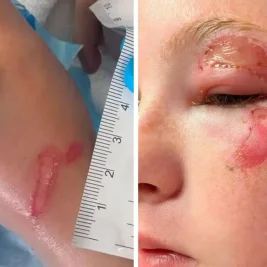 Microwaving Squishy Toys Burns Children: Doctors Issue Urgent Warning