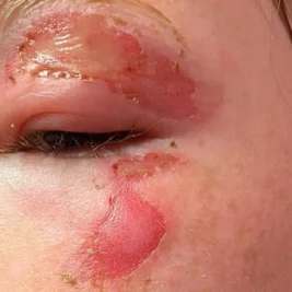 Exploding Microwaved Squishy Toys Burn Six Children in Scotland