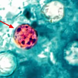CDC Monitors Rise in Cyclospora Cases, Texas Among Hardest Hit