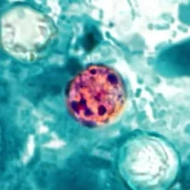 CDC Probes Cyclospora Outbreak With Over 1,600 Cases Across US