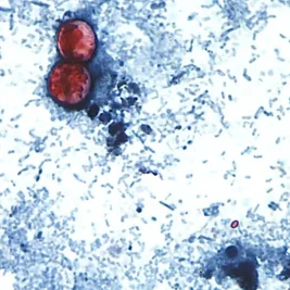 Cyclospora Outbreak Sickens Over 2,000 Across 21 US States